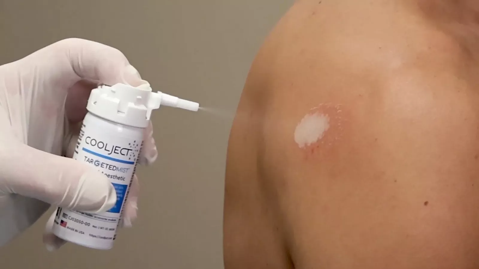 Comparing Thermal vs. Chemical Blockade in Topical Anesthetic Applications