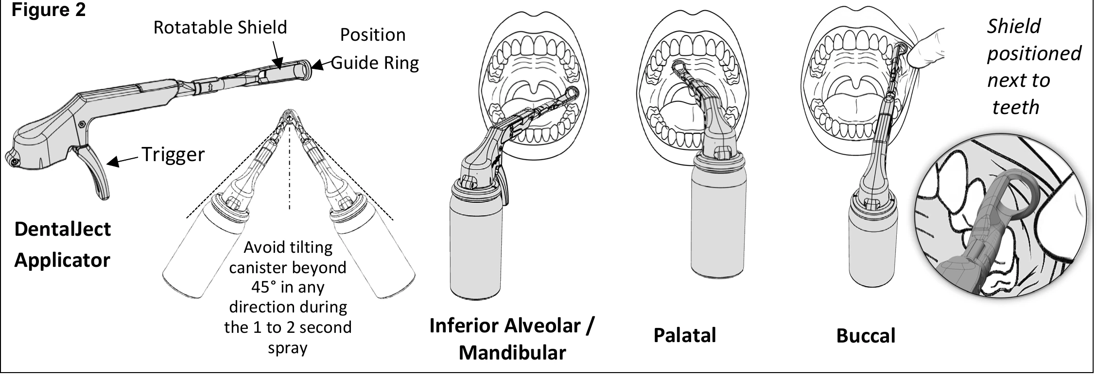 Figure 2: the DentalJect applicator labelled with its rotatable shield, guide ring and trigger, a diagram warning against tilting the canister beyond 45° during the 1 to 2 second spray, and three intraoral views showing inferior alveolar / mandibular, palatal and buccal application with the shield positioned next to the teeth.